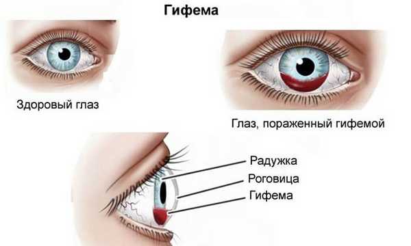 гифема