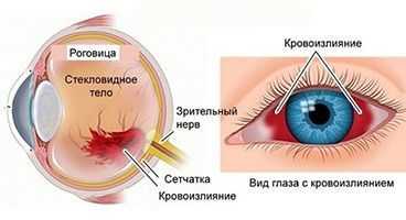 Кровоизлияние в глаз