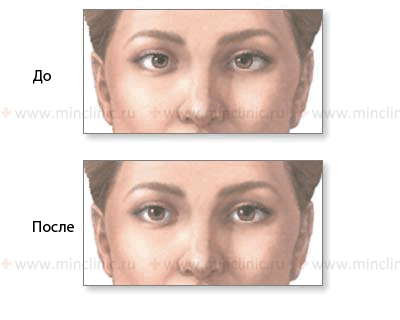 Показана слабость латеральной (наружной) прямой мышцы правого глаза (VI пара черепно-мозговых нервов) до и после лечения.