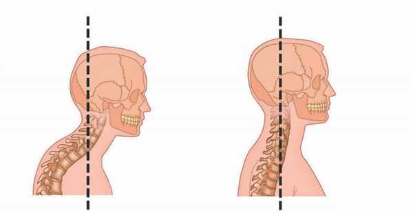 шейный лордоз