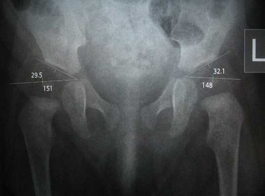 Рентгенография тазобедренного сустава: для чего проводится