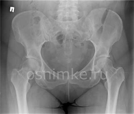 Снимок тазобедренного сустава