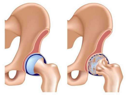 Рентгенография тазобедренного сустава: для чего проводится
