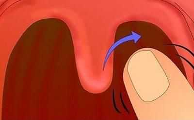Прием для вызова рвоты