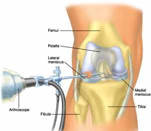 Схема артроскопии