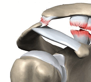 Разрыв акромиально ключичного сочленения операция