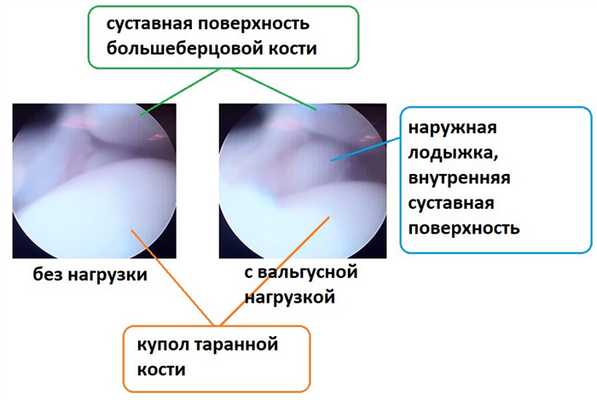 артроскопия голеностопа