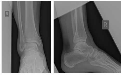рентгенография голеностопного сустава - норма