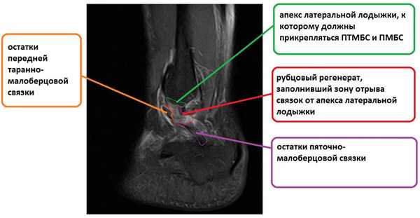 мрт голеностопного сустава, отрыв передней таранно-малоберцовой и пяточно-малоберцовой связок
