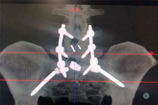 Спондилодез - после рентген после операции