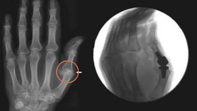 Эндопротезирование пястно-фалангового сустава кисти