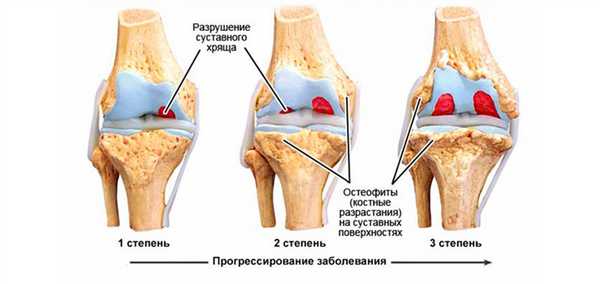 Степени артроза кисти