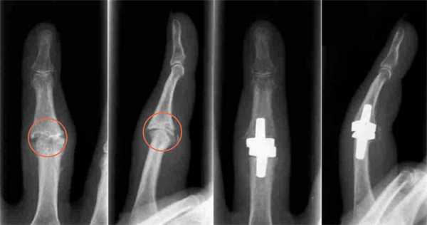 Эндопротезирование проксимального межфалангового сустава кисти