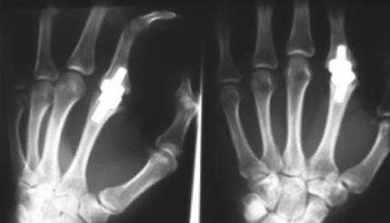 Эндопротезирование пястно-фалангового сустава кисти