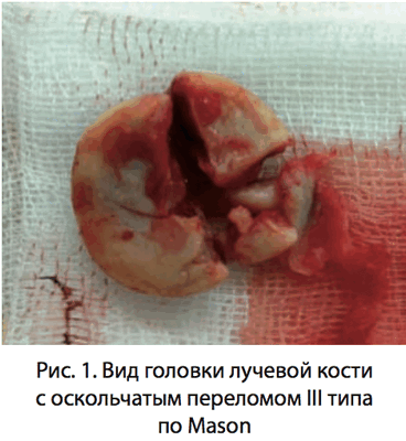 Рис. 1. Вид головки лучевой кости