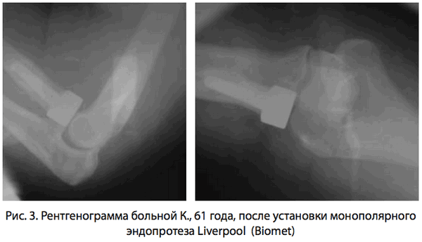 Рис. 3. Рентгенограмма больной К
