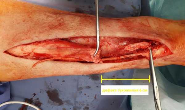 дефект ахиллова сухожилия