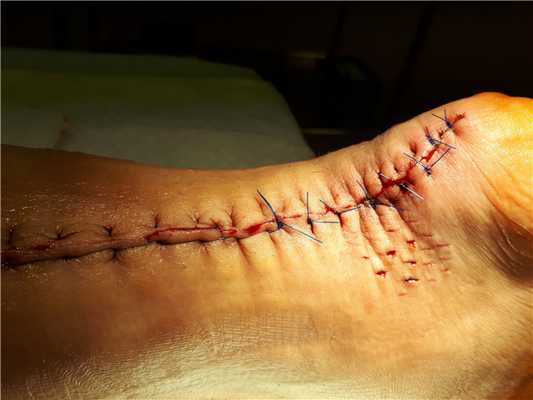 шов ахиллова сухожилия