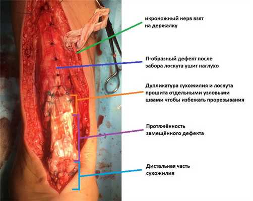 застарелый разрыв ахилла пластика