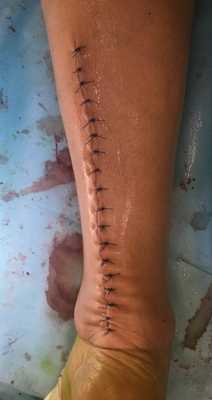 застарелый ахилл пластика операция