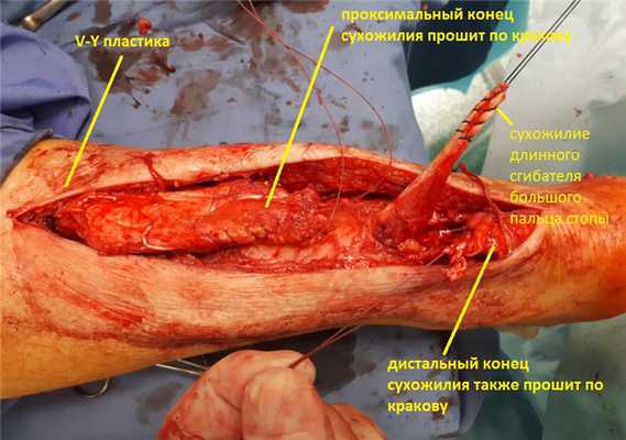 пластика ахилова сухожилия