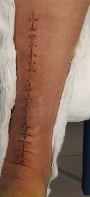 застарелый разрыв ахилла 2 недели