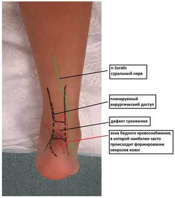Планирование операции при отрыве ахиллова сухожилия