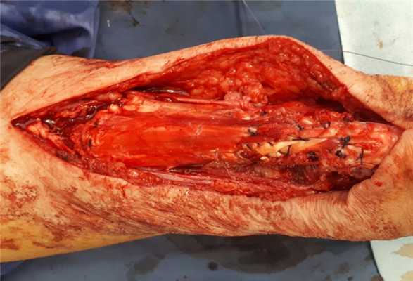 вариант пластики ахиллова сухожилия