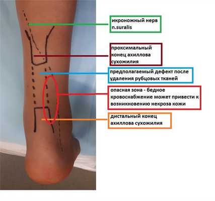 застарелый разрыв ахилла планирование доступа