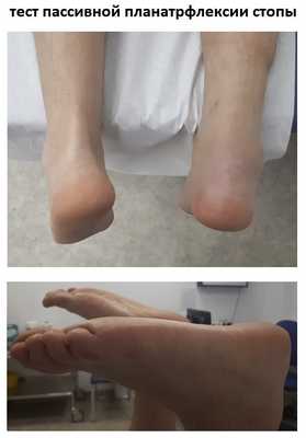 разрыв ахиллова сухожилия тест пассивной плантарфлексии