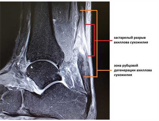 застарелый разрыв ахиллова сухожилия МРТ