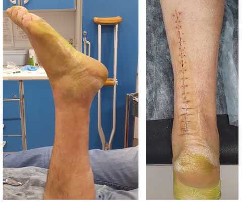 4 недели после пластики ахиллова сухожилия