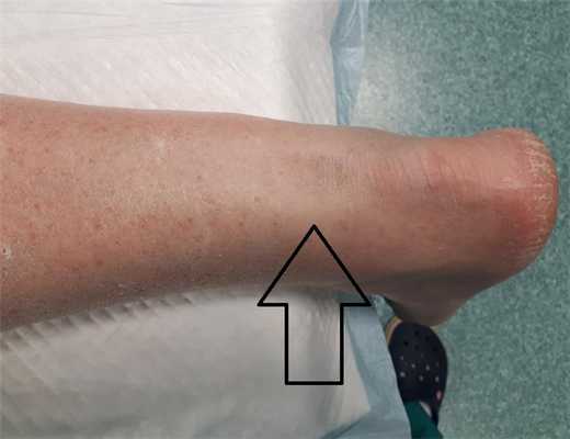 застарелый разрыв ахиллова сухожилия