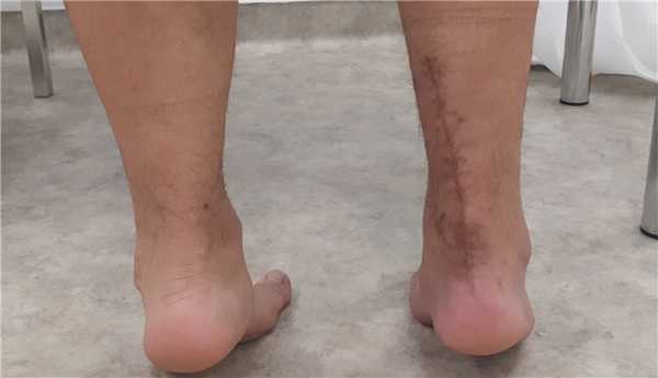 тендинит ахиллова сухожилия после операции