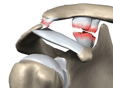Плечо.ру-разрыв акромиально ключичного сочленения плечевого сустава. Хирургия плеча, артроскопия, реабилитация