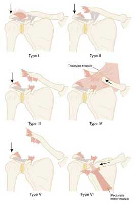 Типы травм АКС