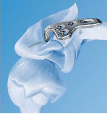 Фиксация ключицы крючкообразной пластиной