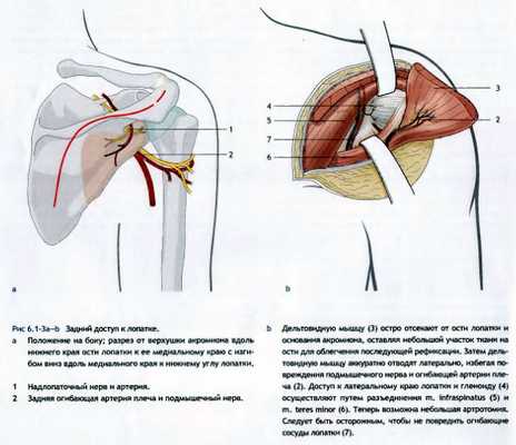 Хирургические доступы при лечении переломов лопатки