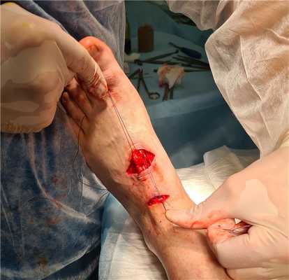 пластика сухожилия стопы