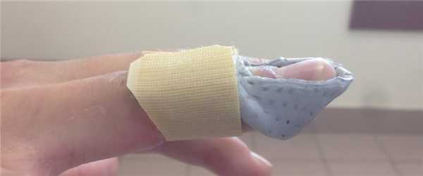 ортез для фиксации дистальной фаланги