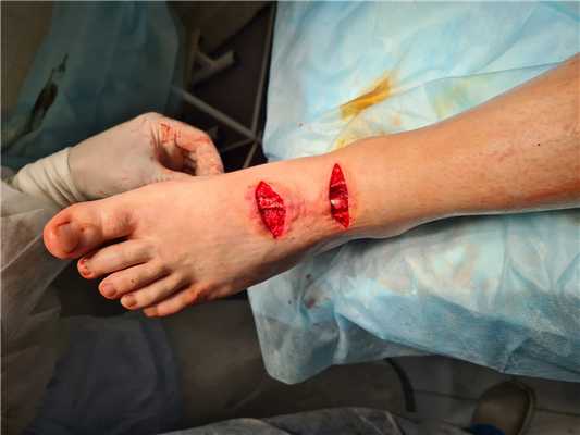 застарелый разрыв сухожилия большого пальца