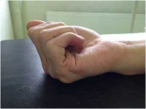 Пластика сгибателя пальца (возвращение подвижности)