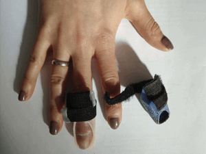 Травма разгибателя пальца (mallet finger)
