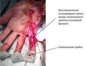 Пластика сгибателя пальца (возвращение подвижности)