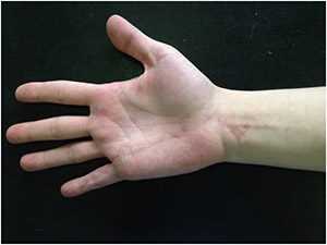 Пластика сгибателя пальца (возвращение подвижности)