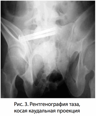 Рис. 3. Рентгенография таза, косая каудальная проекция