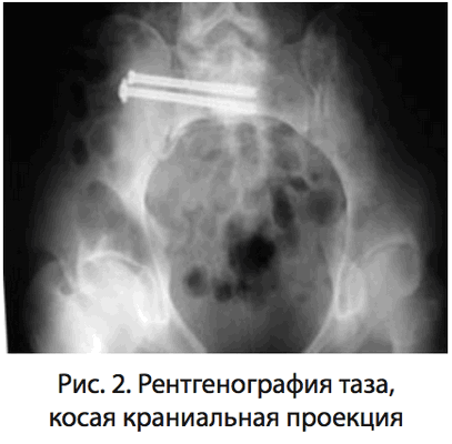 Рис. 2. Рентгенография таза, косая краниальная проекция