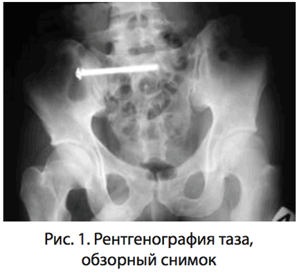 Рис. 1. Рентгенография таза, обзорный снимок