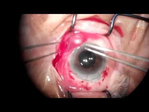 Видео Экстракапсулярная экстракция катаракты