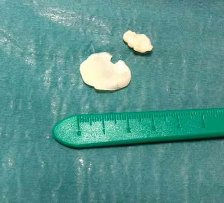 внутрисуставное тело коленного сустава удалено